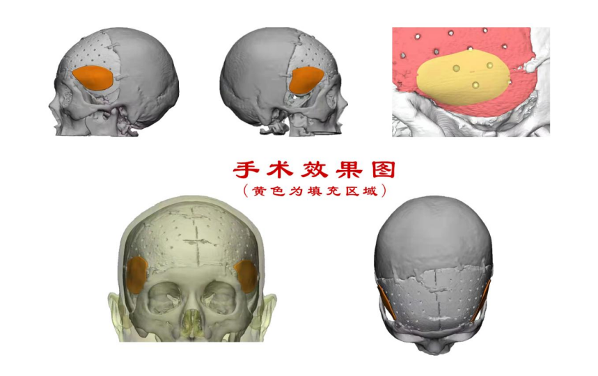 林志穎車禍致顏面骨折，醫(yī)生：或可用3D打印建模進(jìn)行術(shù)后修復(fù)