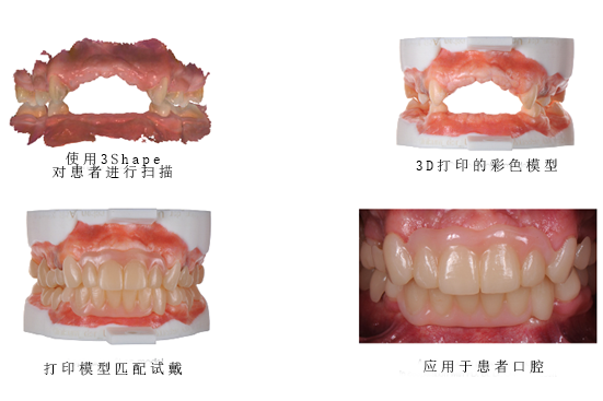 3Shape彩色工作流程，讓牙齒假體越來越“真”！